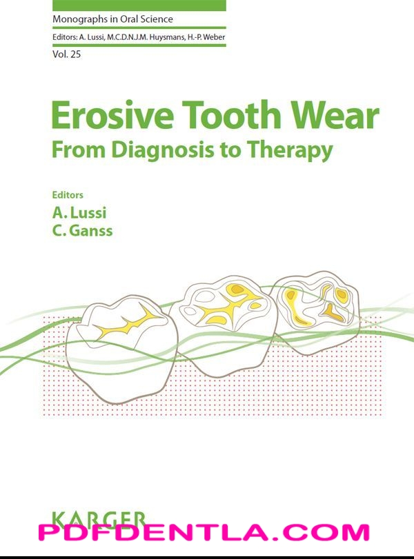 Erosive Tooth Wear From Diagnosis To Therapy Monographs