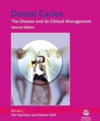 Dental Caries: The Disease and Its Clinical Management (pdf)