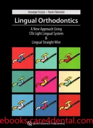 Lingual Orthodontics: A New Approach Using STb Light Lingual System and Lingual Straight Wire (pdf)